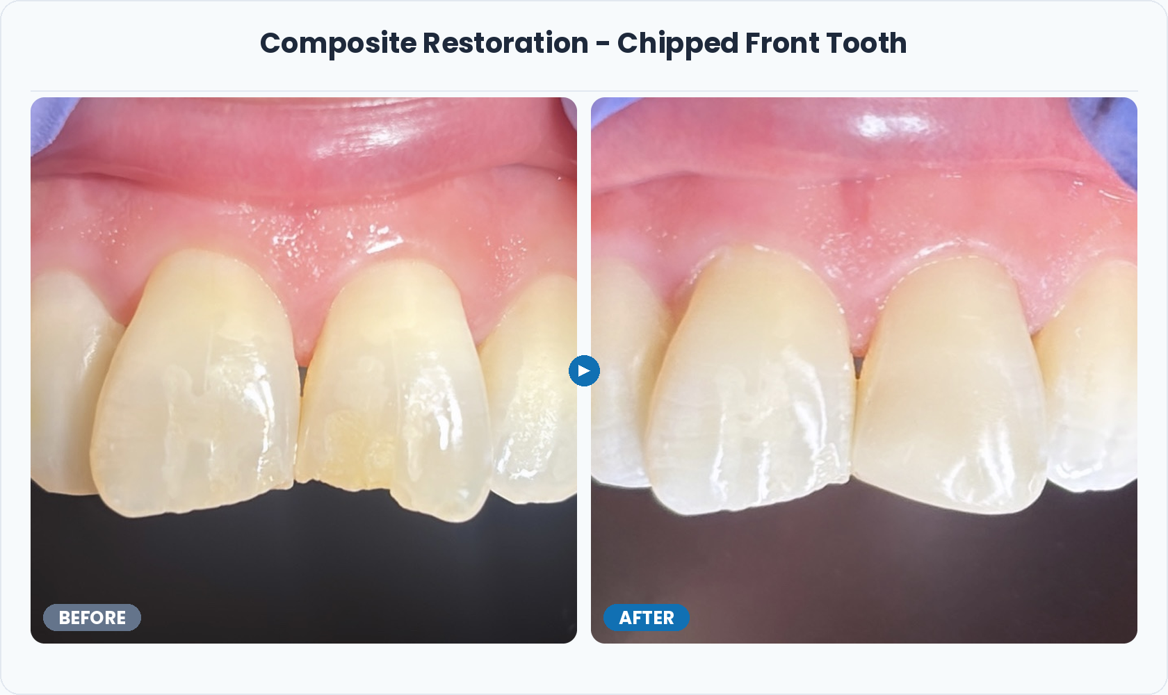 01_Composite_Restoration_Chipped_Front_Tooth