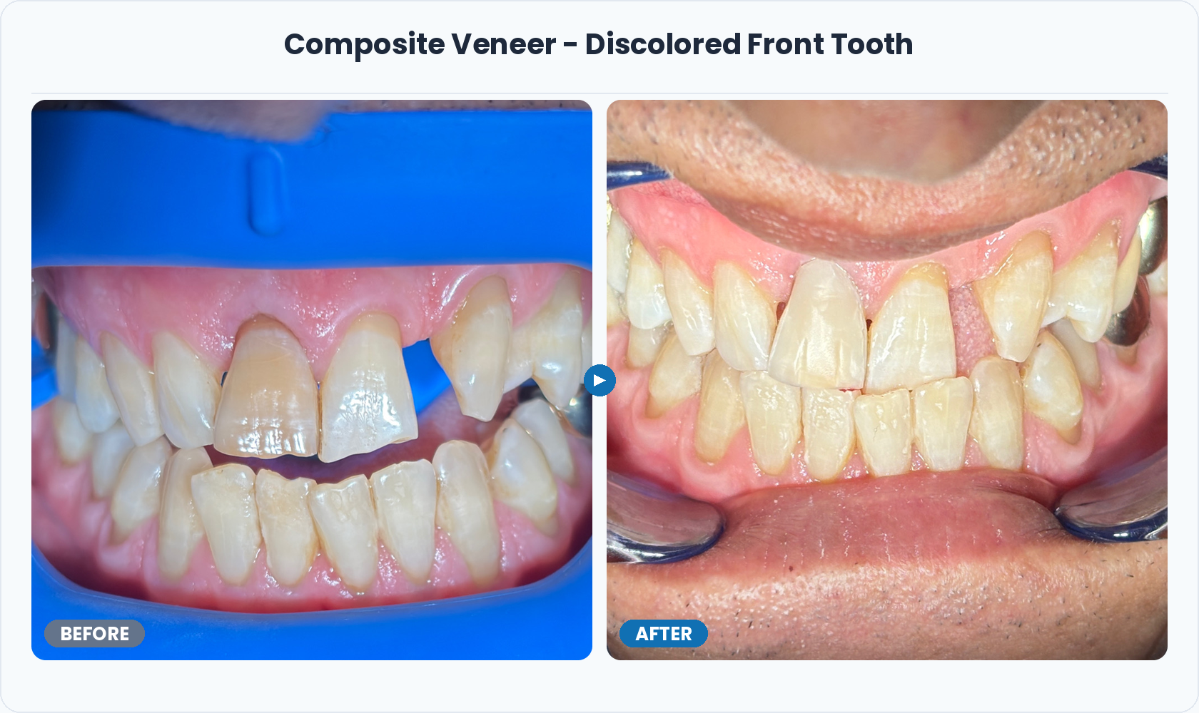 02_Composite_Veneer_Discolored_Front_Tooth