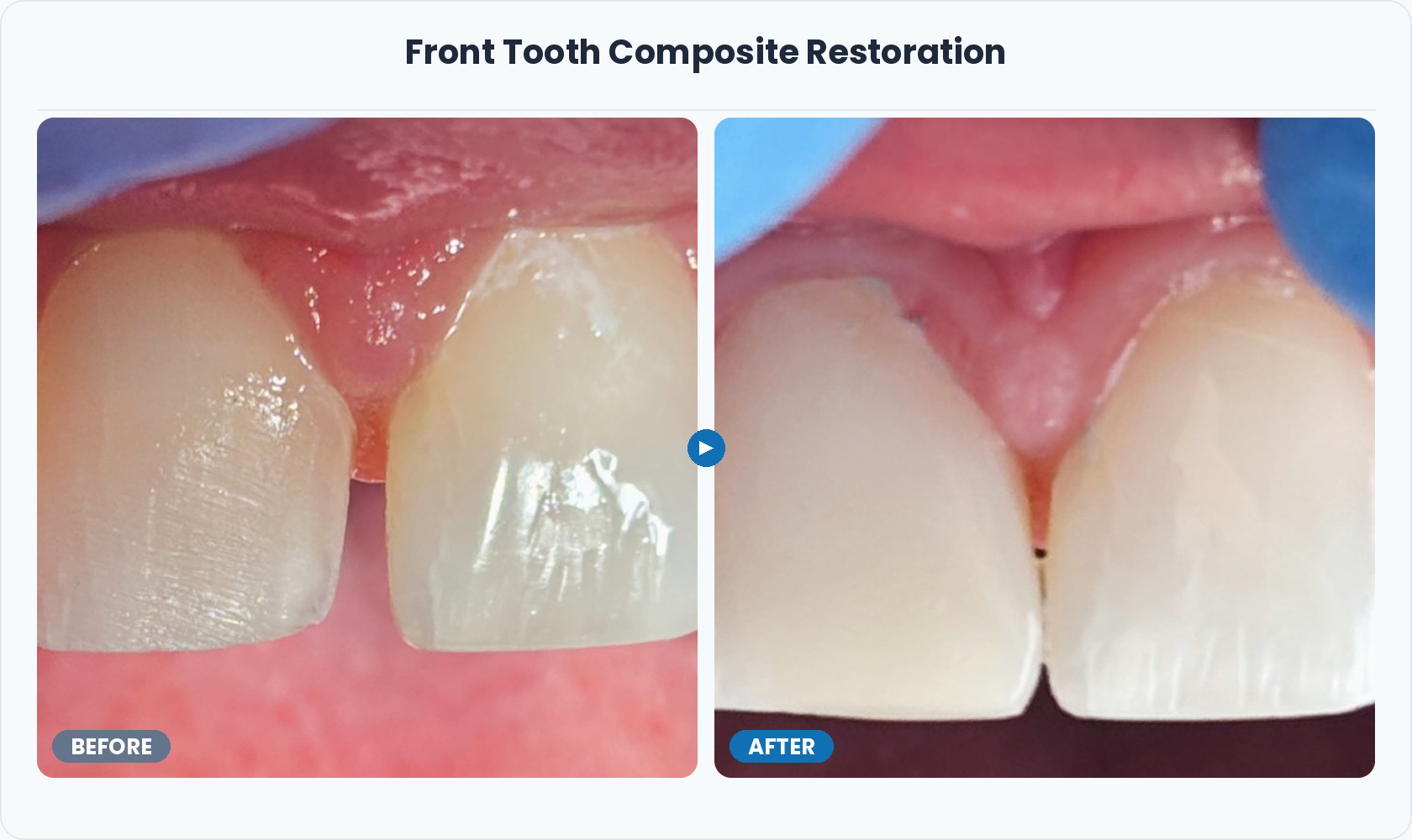 03_Front_Tooth_Composite_Restoration