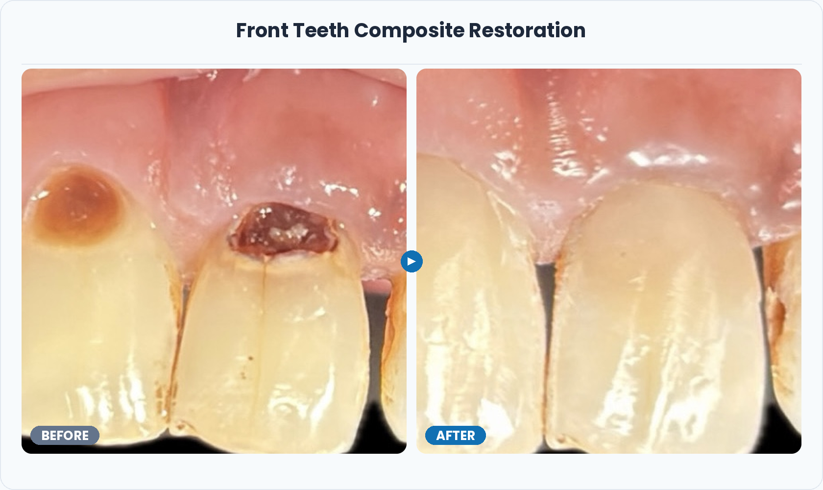 04_Front_Teeth_Composite_Restoration
