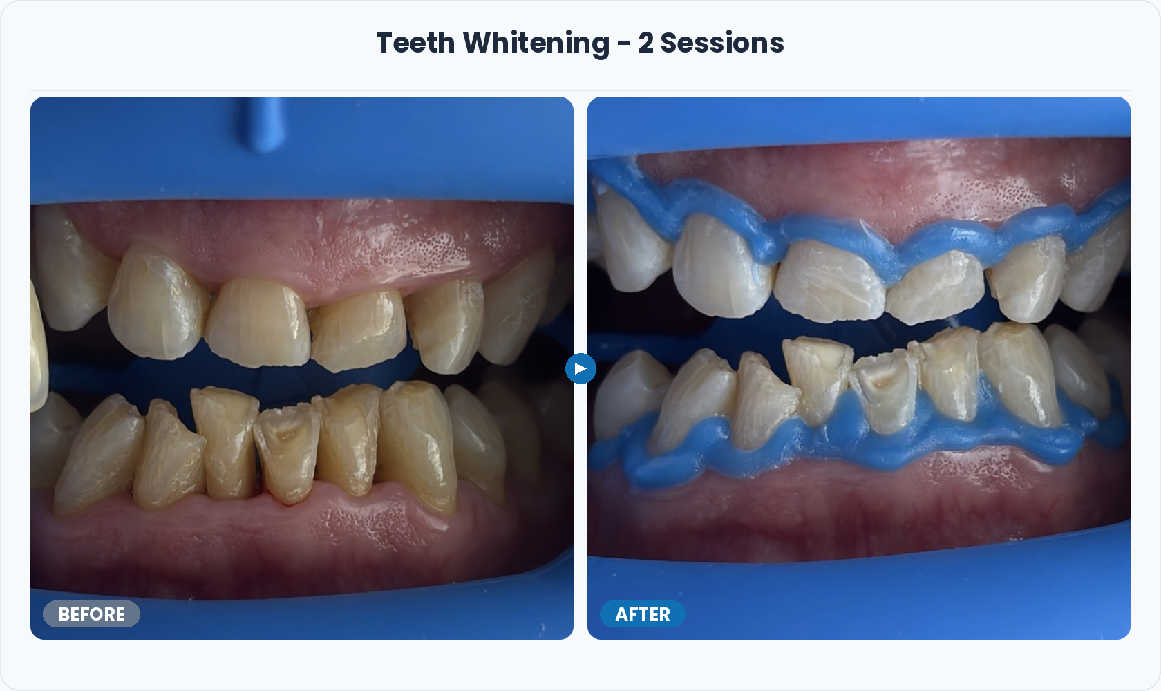 05_Teeth_Whitening_2_Sessions