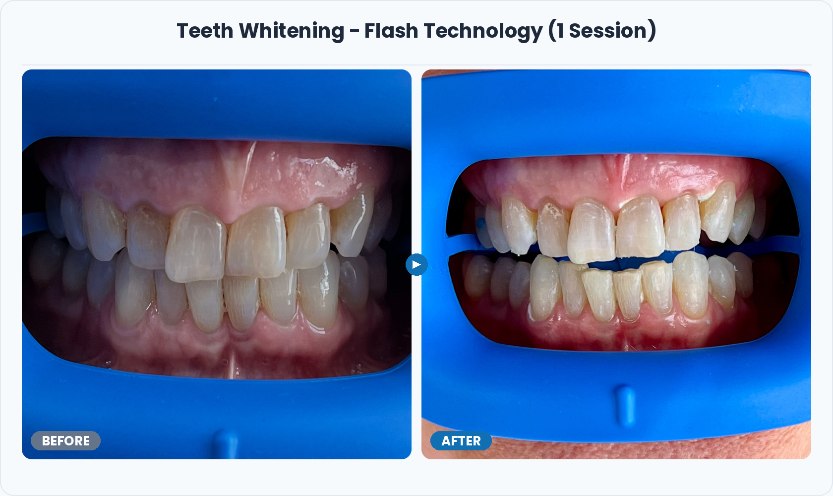 06_Teeth_Whitening_Flash_One_Session