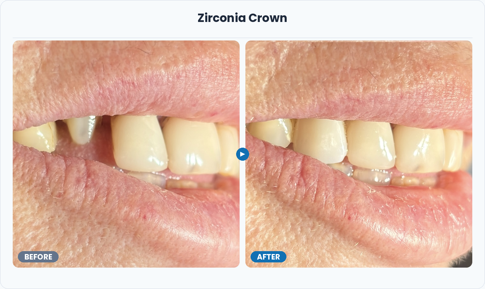 07_Zirconia_Crown