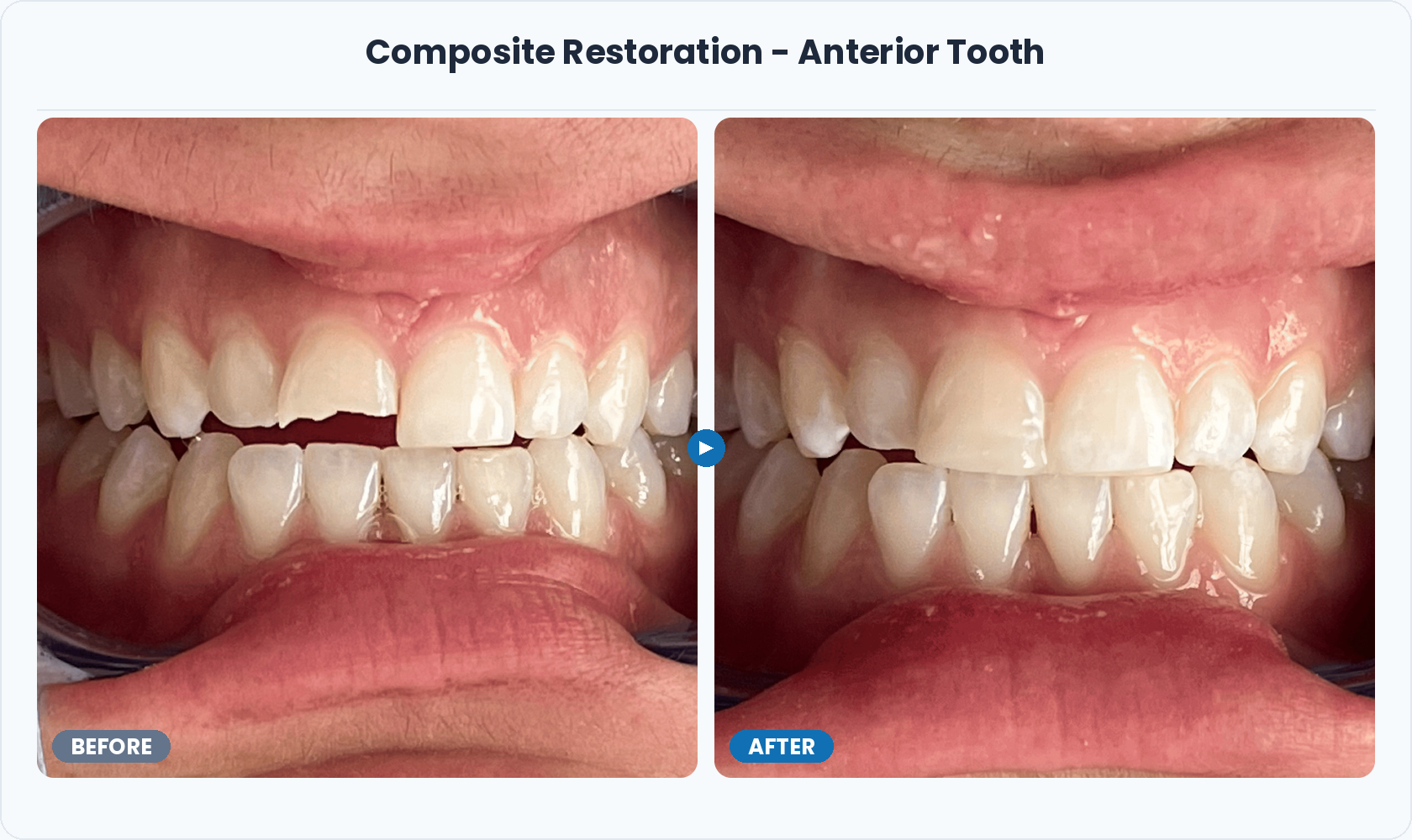 08_Composite_Restoration_Anterior_Tooth