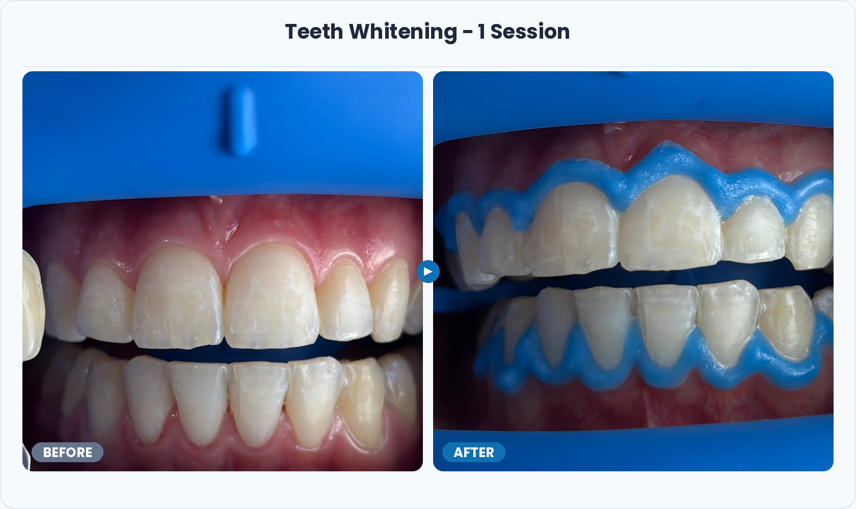 09_Teeth_Whitening_1_Session