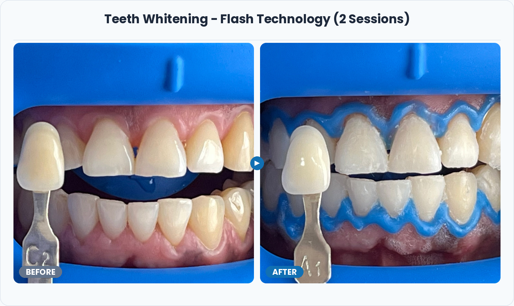 10_Teeth_Whitening_Flash_Two_Session