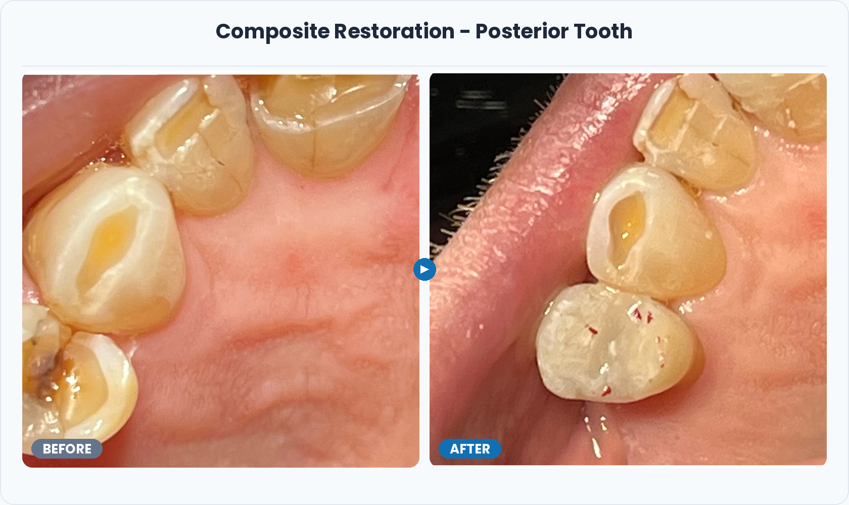 12_Composite_Restoration_Posterior_Tooth