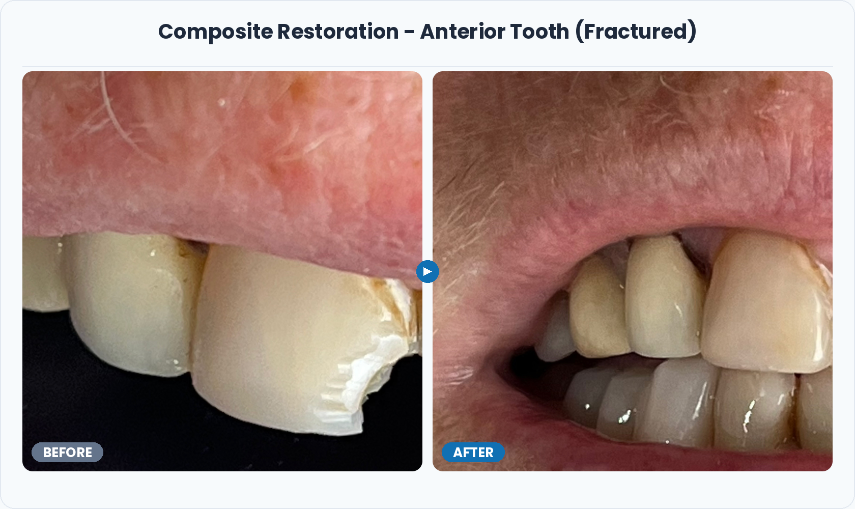 13_Composite_Restoration_Anterior_Fractured