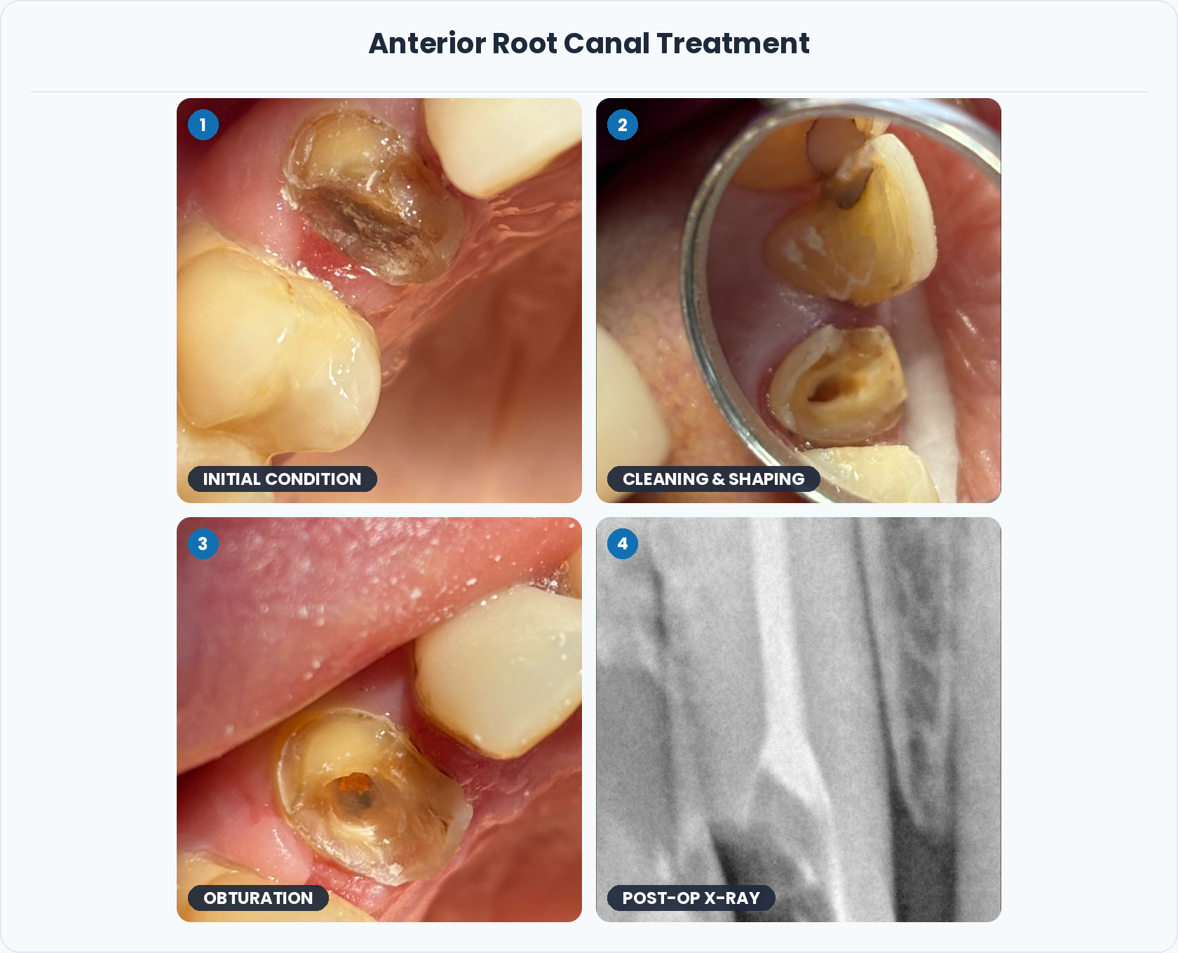 14_Anterior_Root_Canal_Treatment